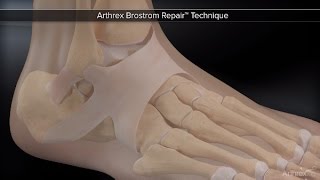 Arthrex Brostrom Repair™