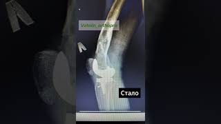 эндопротезирование коленного cустава подробное на так Vatolin_orthopro