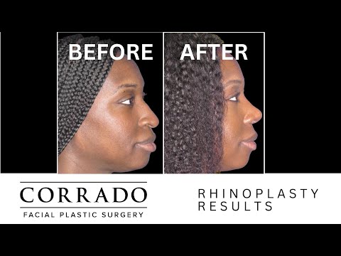 Video thumbnail: Nose Job Transformation: 1-Week After Surgery | Dr. Corrado · Dr. Anthony Corrado