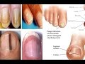 Nail Symptoms and What It Means for Your Health!