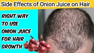 Right Way To Use Onion Juice For Hair Growth | Side Effects of Onion Juice On Hair |Onion Juice