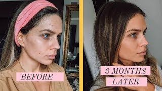 HOW I CLEARED MY SKIN IN 3 MONTHS | 10 TIPS FOR BREAK OUTS screenshot 5