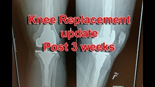 Knee Replacement  Update  Post OP 3 weeks