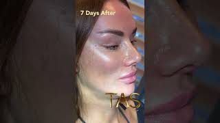 Transformative Facelift Experience with Dr. Tas: Unveiling Timeless Beauty