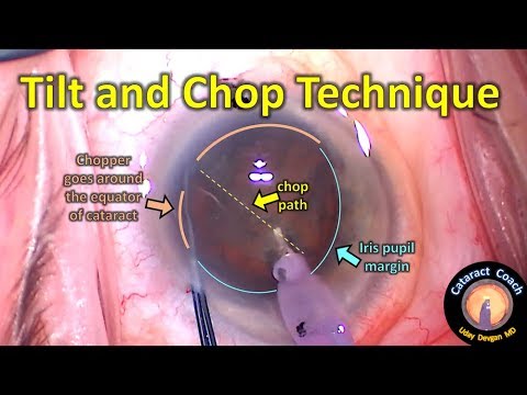 Tilt and Chop phaco technique: supracapsular cataract surgery for a dense nucleus