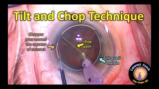 Tilt and Chop phaco technique: supracapsular cataract surgery for a dense nucleus