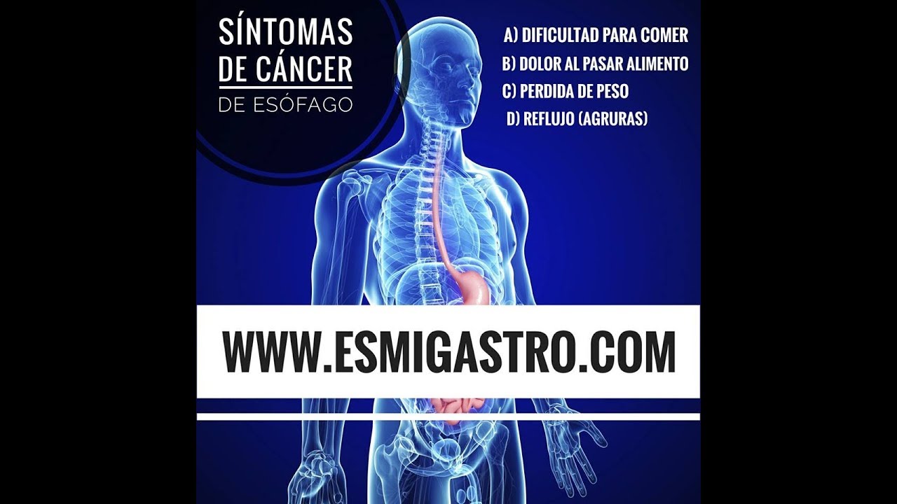 Síntomas del Cáncer de Esófago saludos amigos dvd