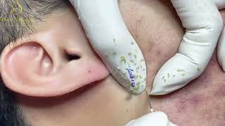 Loan Nguyen Acne Treatment 0080