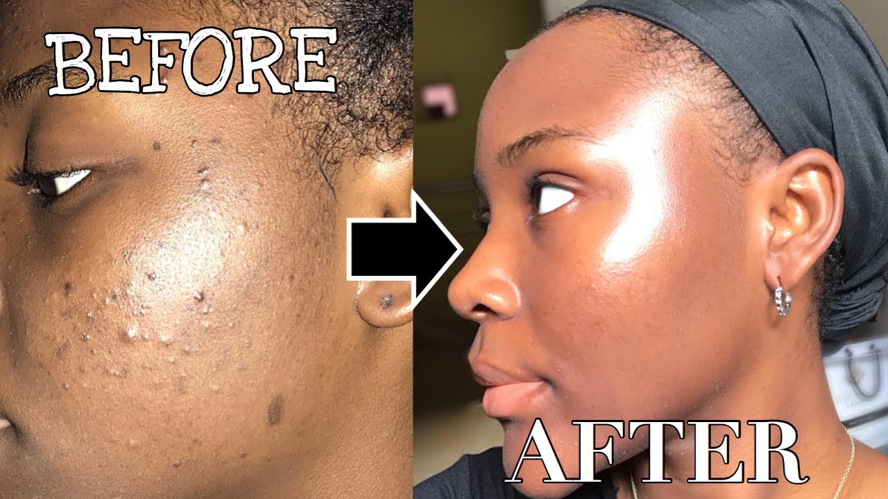 How I Cleared My Skin In A Month Acne Journeyskincare Routine