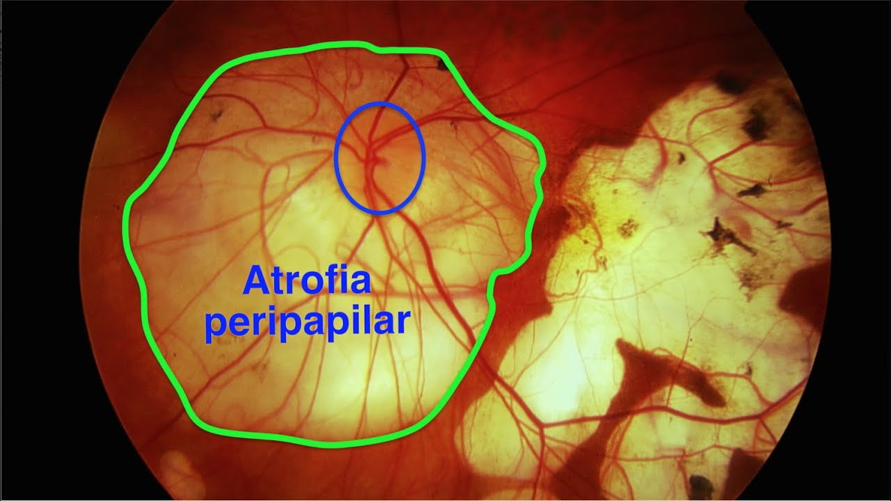 Fondo de ojo en la miopía - YouTube Fondo de ojo en la miopía - YouTube