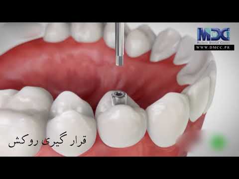 کاشت ایمپلنت به صورت انیمیشن حتما ببینید