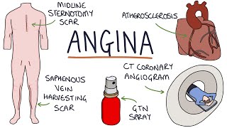 Understanding Angina: Visual Explanation for Students
