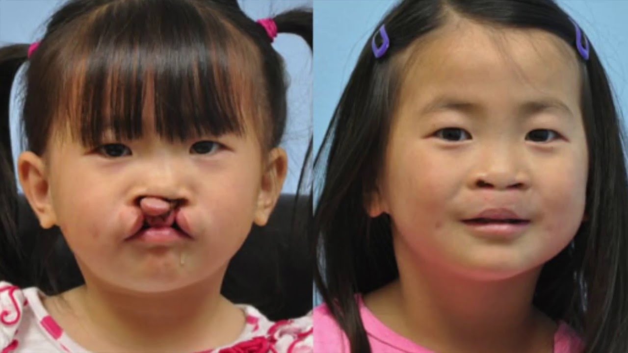 Grant Proposal: Cleft Palate.