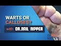 Warts or Calluses?  It is Emily [Callus Tuesday] (2020)