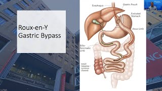 Weight Loss Surgery Q\&A: Roux-en-Y Gastric Bypass
