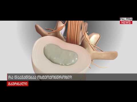 რა დაავადებაა ოსტეოქონდროზი