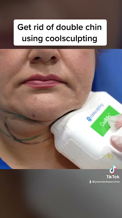 Doublechin removal using coolsculpting #shorts