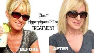 Get Rid Of Chest Hyperpigmentation & Sun Damage