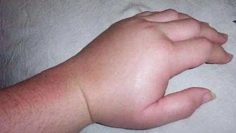 Perché ci si sveglia con le mani gonfie?