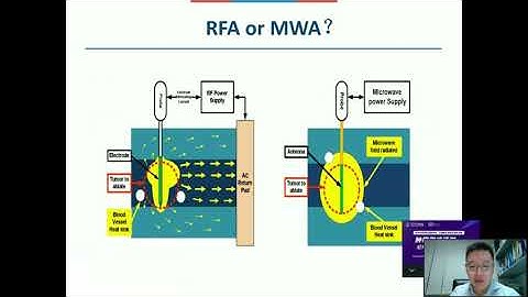 CCMA & SIO Webinar _ Prof. Yang-kui Gu: MDT Based Ablation Strategy of Colorectal Liver Metastases