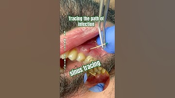 Sinus tracing of a fistula, ⚠️ A pimple on your gums