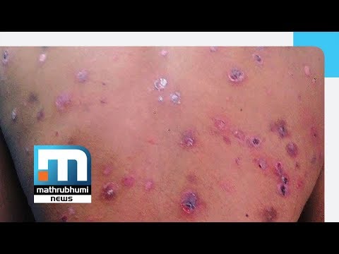 Psoriasis: Treatment Options, Management| Doctor@2PM| Mathrubhumi News