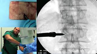 Navigated Wireless Percutaneous Pedicle Screw Placement - Michael Y. Wang, MD