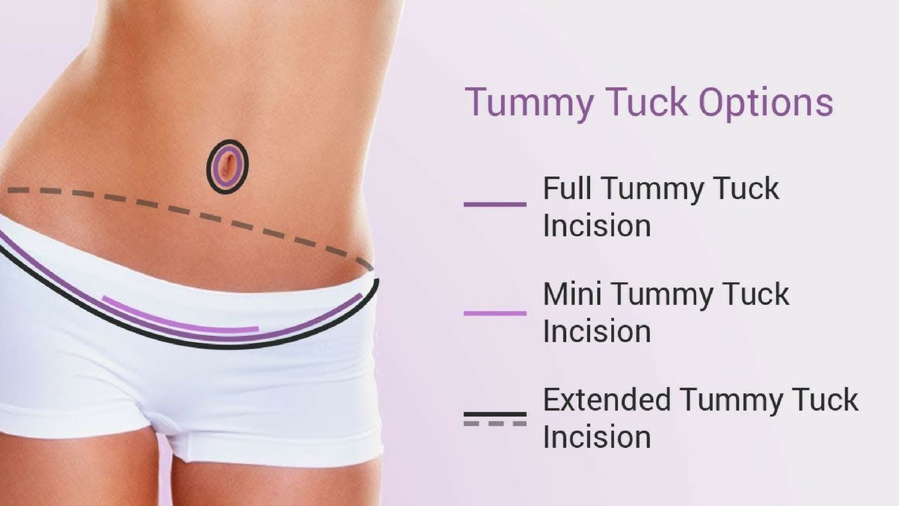 prices for tummy tuck