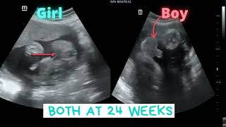 Ultrasound showing Girl- Boy both at 24 weeks screenshot 3