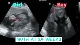 Ultrasound showing Girl- Boy both at 24 weeks