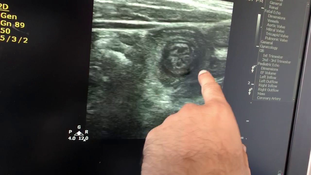 Parasitic infestation with intussusception n inflammed ileum