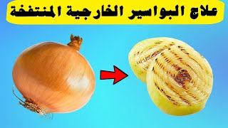 علاج البواسير الخارجية المنتفخة !