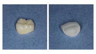 The Benefits of Zirconia Crowns