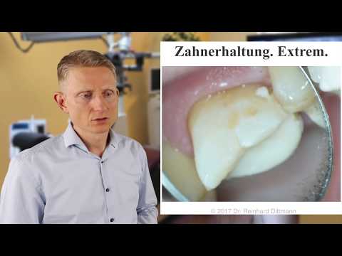Video: Können vernachlässigte Zähne gerettet werden?