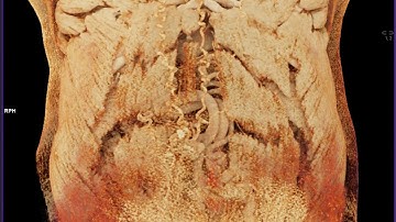 Varices with Cinematic Rendering