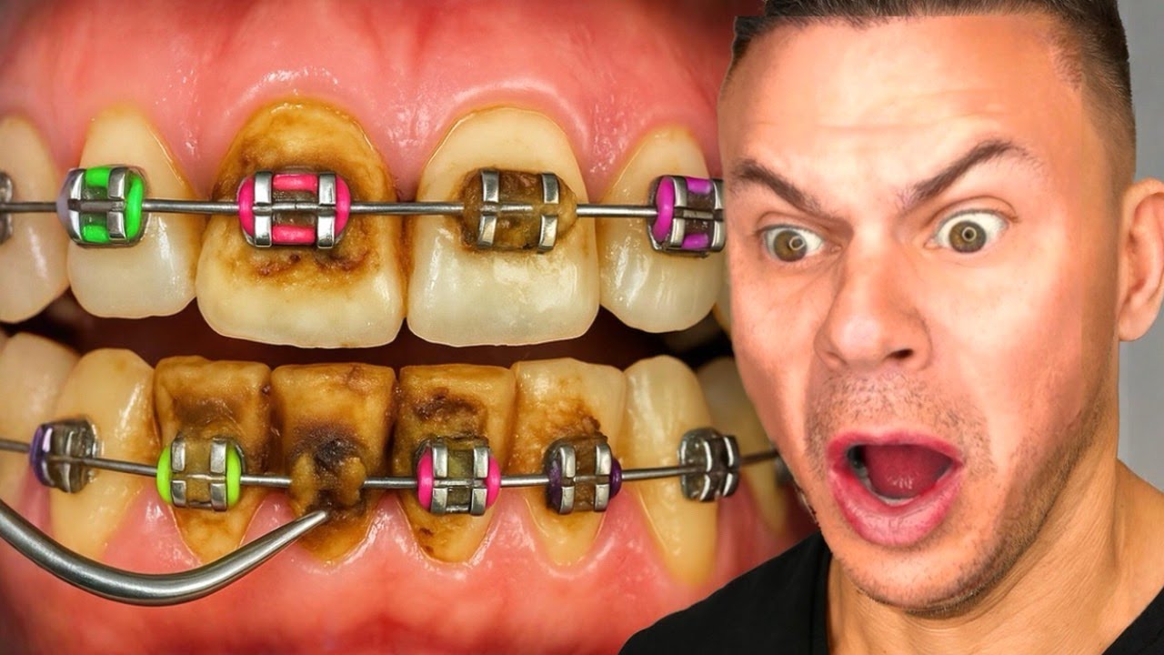 Watching Braces NIGHTMARES So You Don’t Have To