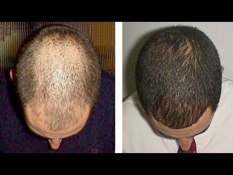 Minoxidil: Use Results Over 6 Months