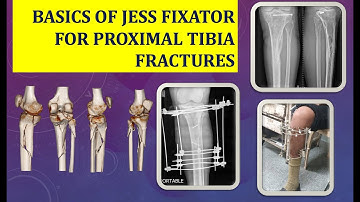 JESS Fixator Technique Basics for Proximal Tibia Fractures (Helmet Frame)