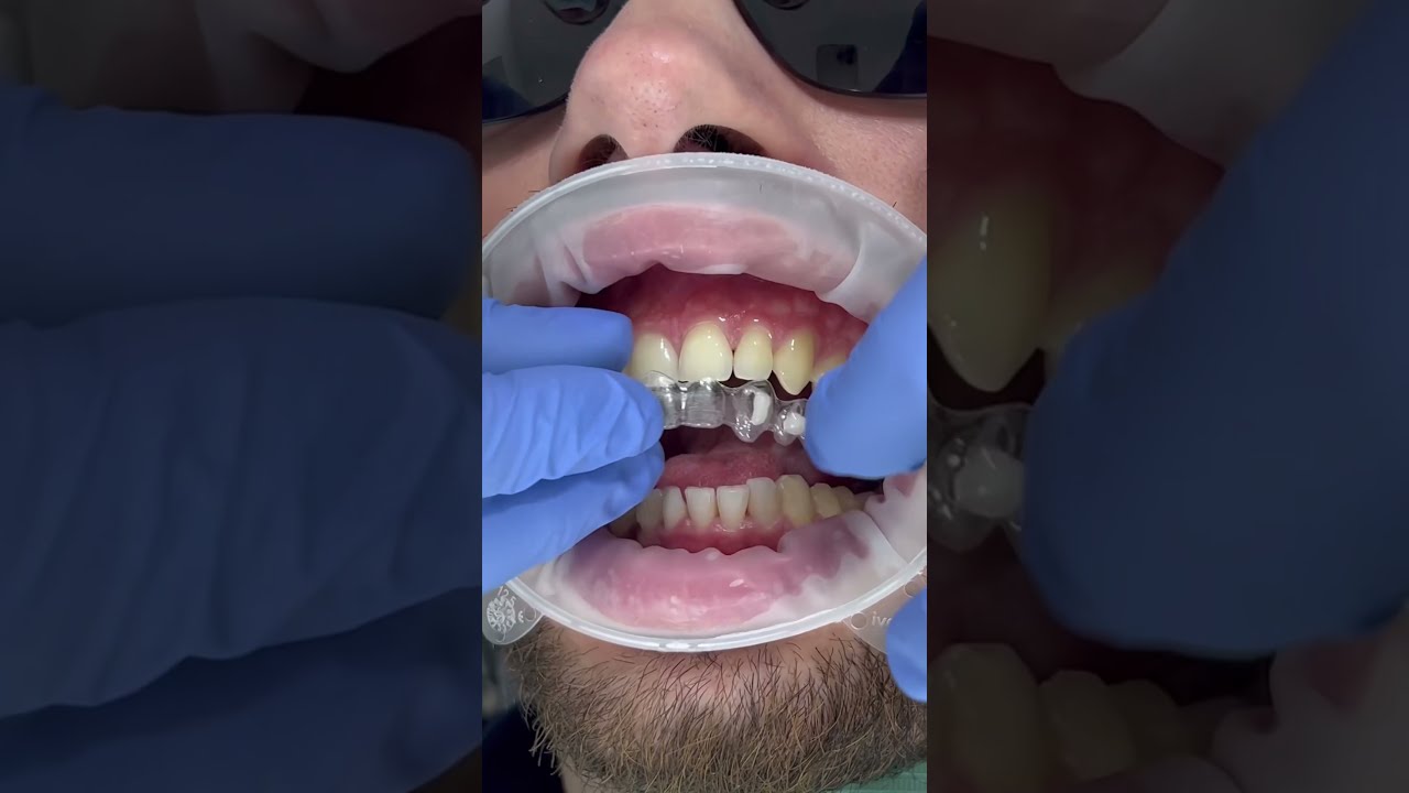 Attachments Are Placed At Precise Locations To Allow The Aligners Grip Teeth Invisalign