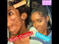 How I cured my SEVERE cystic acne / Skincare Routine 2019