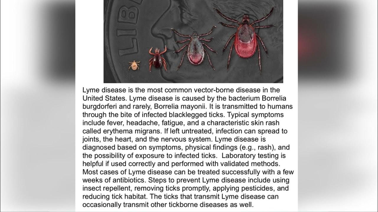 Testing for Lyme Disease USMLE Review Med Live Podcast YouTube