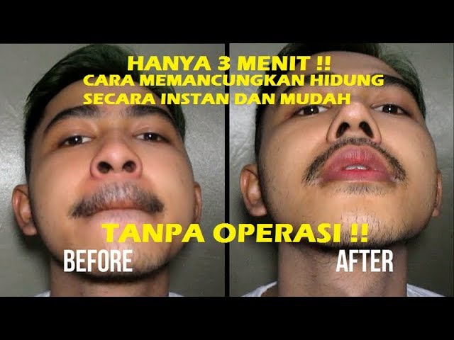 Alat Pemancung Hidung Instan Dengan Cotton Bud Youtube Alat Pemancung Hidung Instan Dengan Cotton Bud Youtube