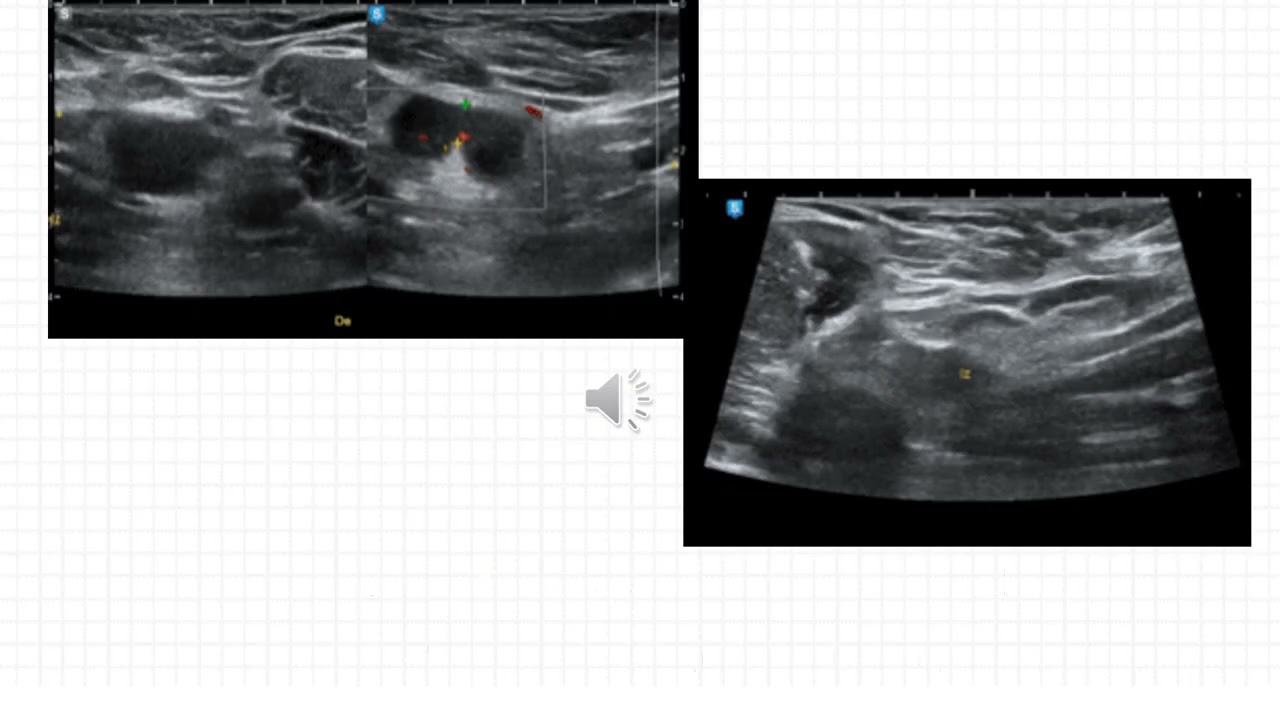 Caso del Mes n°229 Octubre 2025 "Enfermedad por Arañazo de Gato" Dra. Chicala López Virginia