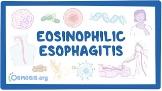 Eosinophilic esophagitis (NORD)