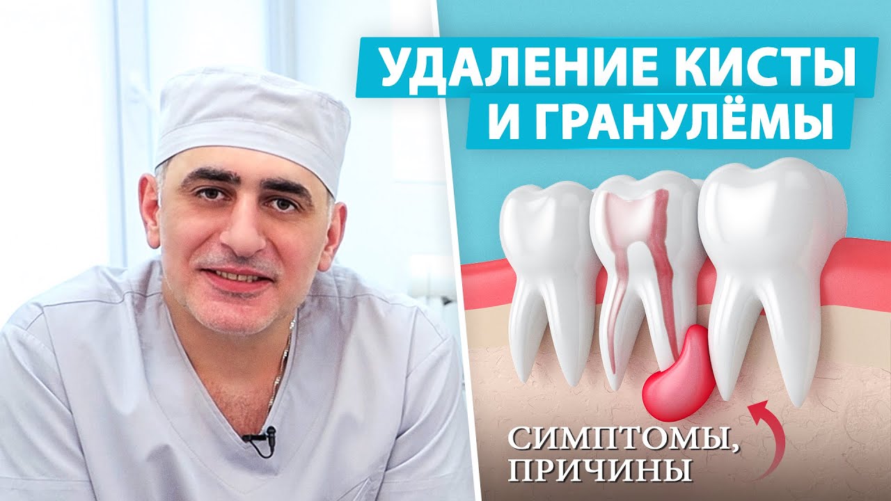 Киста зуба: как проходит лечение? - YouTube