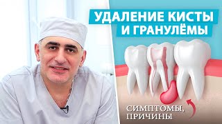 Киста зуба: как проходит лечение?