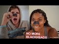 BEST WAY TO REMOVE BLACKHEADS (Easy)