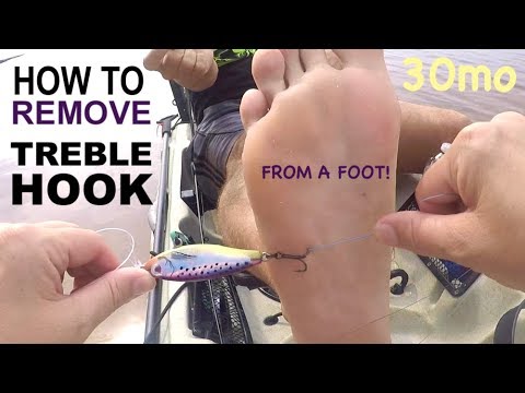 HOW TO REMOVE A TREBLE HOOK FROM FOOT 