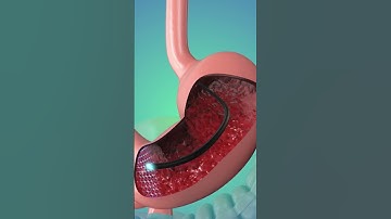 Removing a Stomach Tumor: Step-by-Step Surgery Guide for Beginners!