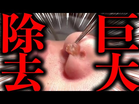 【大公開】巨大ほくろをブっこ抜く！！この神業に注目！